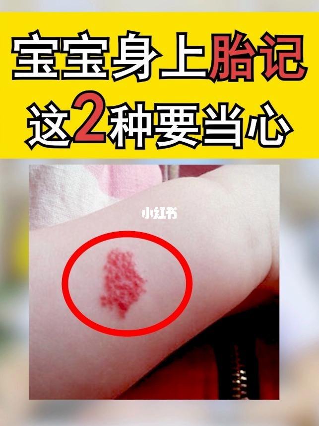 为什么婴儿有胎记 为什么婴儿有胎记的原因